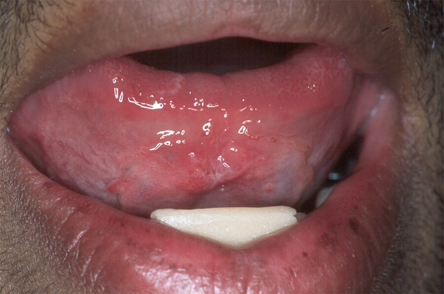 Foto Nº 6: Post-operatorios al mes después segunda intervención