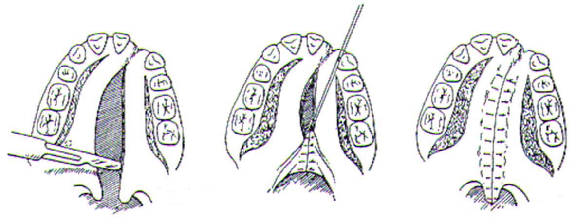 Figura N°1. Fuente: Cirugía Bucal de H. Archer