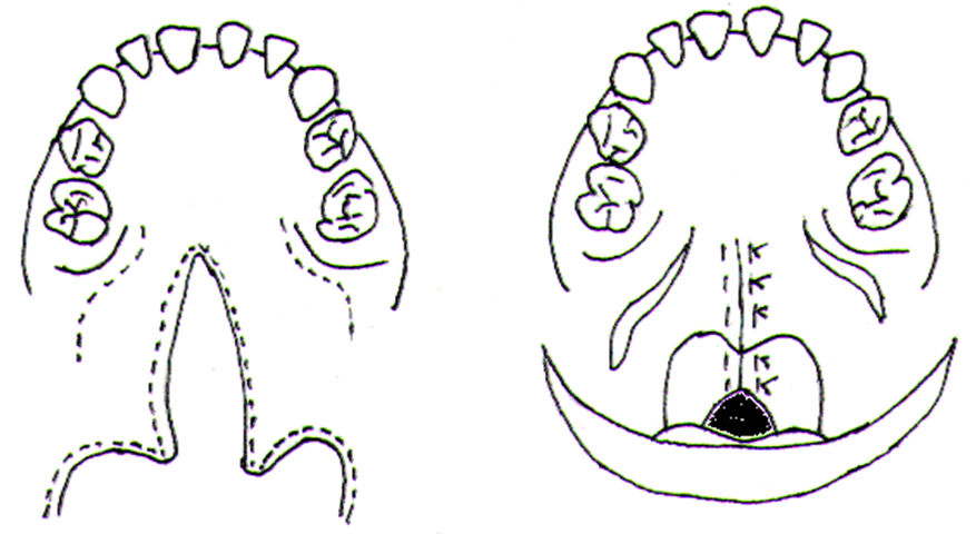 Figura N° 5. 1. Incisiones 2. Sutura.