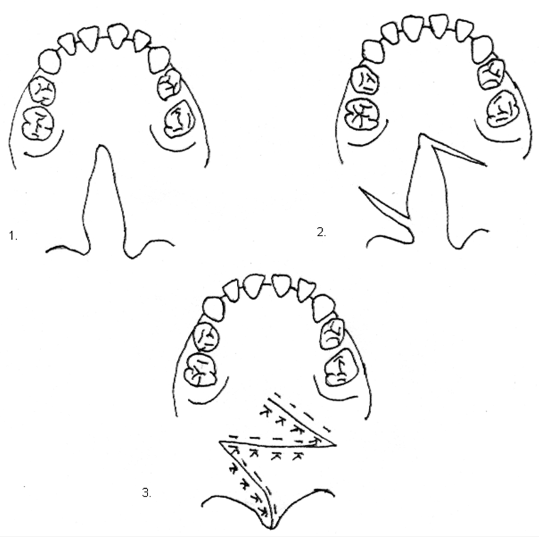 Figura N° 6. 1. Paladar hendido 2. Incisiones 3. Sutura.