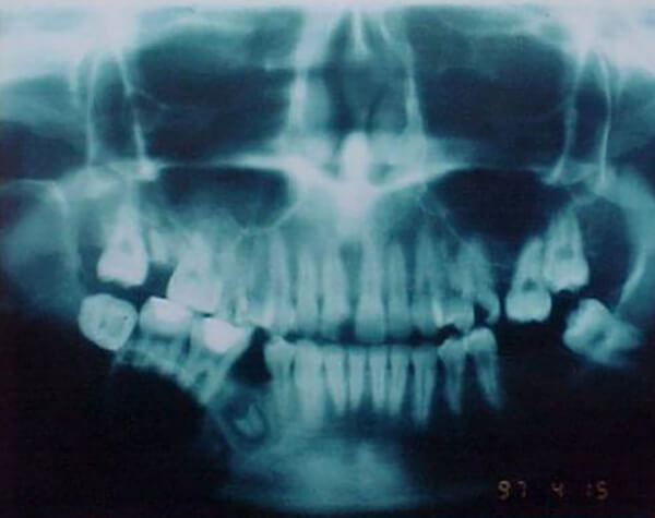Figura 5. Radiografía Panorámica. Se observa imagen radiolúcida multilocular rodeada de un halo radiopaco de 7x5x4 cm que se extiende desde la zona del 45 hasta la Escotadura Sigmoidea. Se observa imagen compatible con resto radicular.