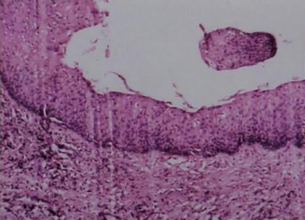 Figura 7. Imagen histopatológica. Epitelio plano estratificado con una capa de paraqueratina. Islotes de epitelio. Estroma inflamado. Pared de quiste con fibrosis e inflamación acentuada.