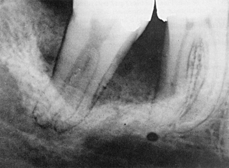 Figura 1 – TOE: aspecto radiográfico en el proceso alveolar Fuente: Goldblatt, 1982