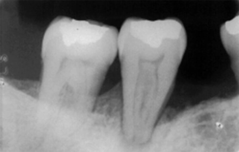 Figura 3 – Diagnóstico diferencial con enfermedadperiodontal Fuente: Propia