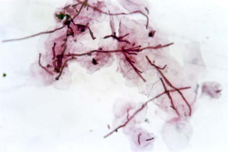Figura 3 - Examen citopatológico por la coloración de PAS - 100X: presencia de hifas y esporos de Candida.