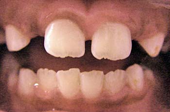 Figura 5 - Erupción dental completa después de 30 días.