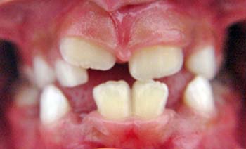 Figura 7 - Erupción dental completa después de 28 días.