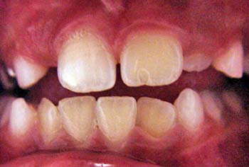 Figura 9 - Erupción dental completa después de 30 días.