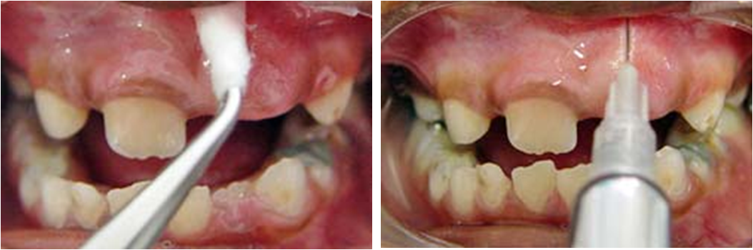 Figura 2 - Anestesia tópica (A)  Anestesia infiltrativa (B)