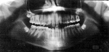 Fig. 4 Radiografía panorámica.
