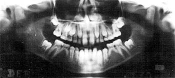 Fig. 5 Radiografía panorámica
