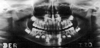 Fig. 6 Radiografía panorámica.