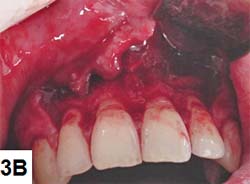B) incisión oblicua en distal del diente 22 y otra en distal del 12, sin abarcar la papila. Incisión intra – surcular y un colgajo de espesura total hasta la cresta ósea. Colgajo de espesura parcial próximo a la línea mucogingival permitiendo mayor movilidad del colgajo para el posicionamiento para coronal. El epitelio de las papilas fue removido con el objetivo de permitir la adecuada unión al colgajo que será suturado.