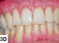 D) 12 meses de acompañamiento del dientes 11, 12, 21 y 22.