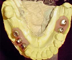 Figura 1 - Intermediarios posicionados