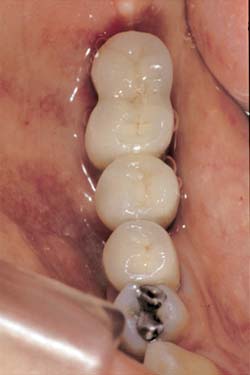 Figura 11 - Vista oclusal de la prótesis definitiva cementada