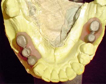 Figura 4 - Vista oclusal de los "copings"