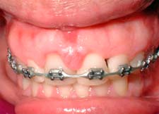 Figura 1: Absceso Gingival Agudo en la zona de incisivos centrales maxilares en paciente adulta que asiste a consulta