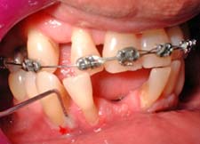 Figura 3: Perdida de inserción periodontal de 8mm en la zona del Absceso Periodontal en paciente adulto que asiste a consulta