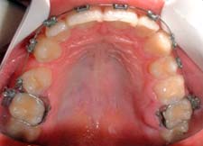 Figura 5: Absceso Gingival producido por mal posición de banda de ortodoncia en la zona del 1er. molar maxilar izquierdo en paciente joven que asiste a consulta