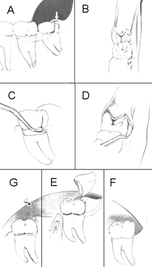 Figura 8: Tratamiento del absceso pericoronario agudo (17) . A) Colgajo pericoronario inflamado (flecha) en relación al 3° molar inferior, B) vista anterior del 3° molar y el colgajo. C) vista lateral con raspador en posición para eliminar suavemente los restos debajo del colgajo, D) vista anterior del raspador en posición, E) eliminación de la sección de la encía distal al 3° molar, después de que los síntomas agudos descienden. La línea de incisión se indica con línea punteada, F) apariencia del área cicatrizada, G) incorrecta eliminación de la punta del colgajo, que permite que permanezca la bolsa profunda distal al molar.