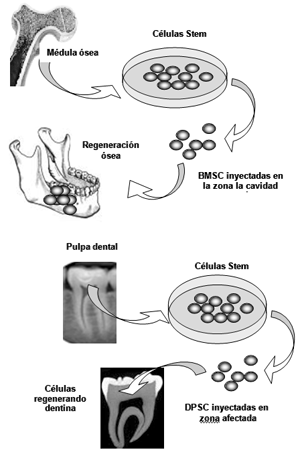 Figura 1. Células Madres adultas pueden ser tomadas de varios tejidos y cultivadas in vitro. Cuando se implantan en el sitio que se encuentran alterado las células Madres tienen el potencial de regenerar hueso y estructuras dentales.