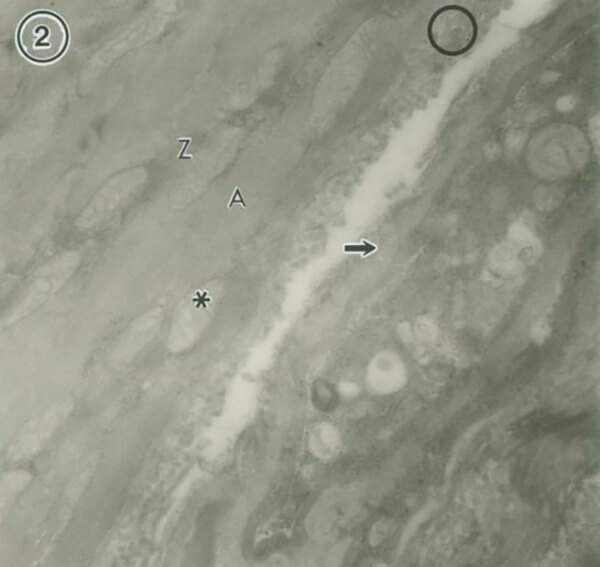 Figura 2 En esta micrografía electrónica, Z: línea Z; A: banda A; círculo: filamentos de colágeno; asterísco: mitocondria de baja densidad electrónica; flecha: membrana basal del capilar. Aumento: 30.000.