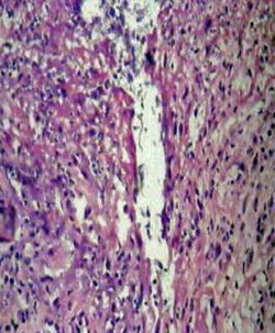 Foto Nº 5 Necrosis, Fibrina e Infiltrado