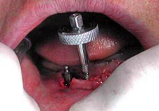 Fig. 3. Inserción de implantes IMETI con la O Ring.