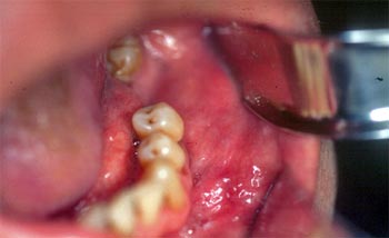 Figura 2. Imagen clínica intrabucal