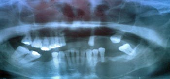 Figura 3. Rx Panorámica