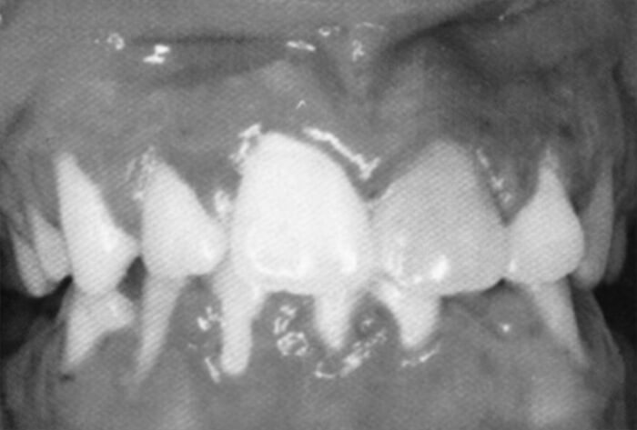 Figura 1: Gingivoestomatitis herpetica primaria: eritema difuso típico. 7