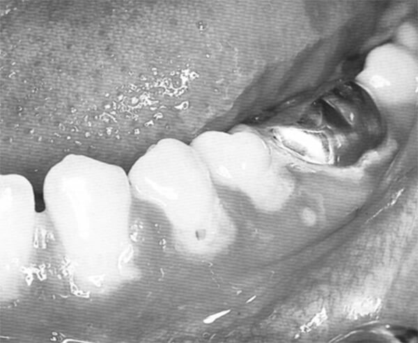 Figura 2: Gingivoestomatitis herpetica primaria: se observa que las ulceras afectan al margen gingival pero no a lãs papilas interdentales principalmente. La ulcera circular de la encía del 2do. premolar es muy indicativa del diagnostico. 53