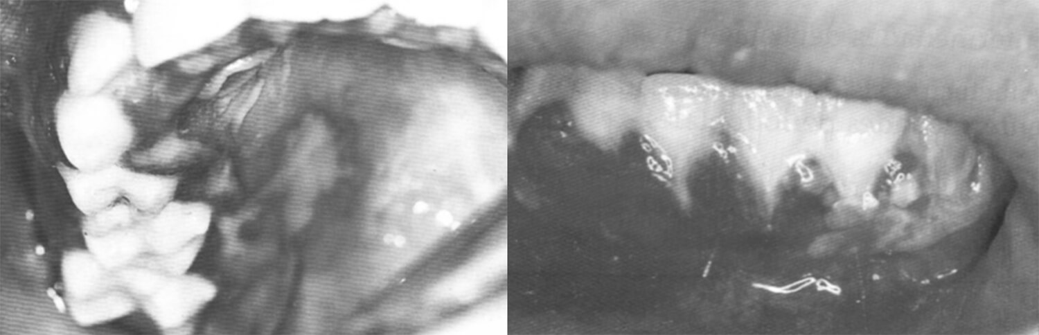 Figura 5: Gingivoestomatitis herpetica primaria: produce exema sensibilidad impidiendo el comer. 53-55