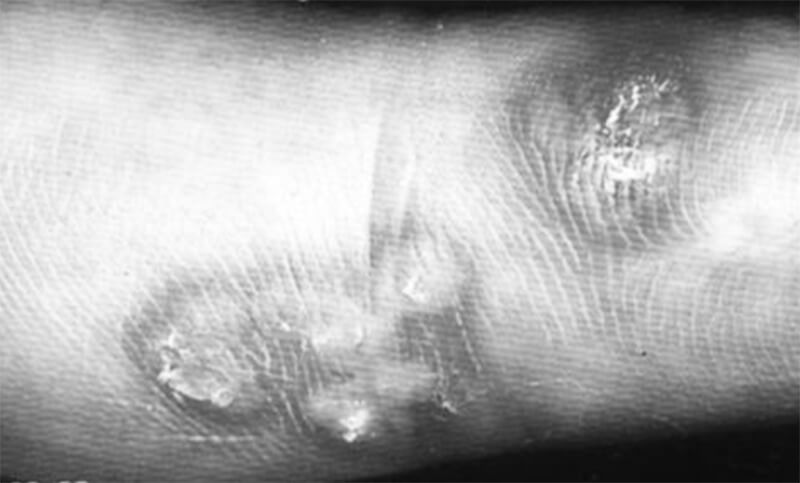 Figura 7: ejemplo típico de la consecuencia cuando el odontólogo no usa guantes: vesículas herpéticas en el dedo. 54