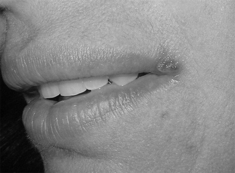 Figura 8: Lesión de herpes simple ubicada en la comisura del labio en paciente adulta femenina que asiste a consulta