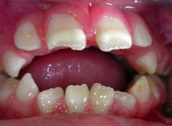Fig. 2. Mordida Abierta Anterior