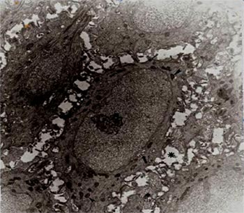 Fig.1 En esta micrografía electrónica se puede observar entre las células de la capa basal espongiosis con pérdida de desmosomas (*). Así mismo se aprecia un Aparato de Golgi atípico (↑), mitocondrias pleomórficas y electrondensas (▲), aún cuando en algunas áreas pueden estar edematizadas (¤). En cuanto al núcleo, se observa un nucléolo a manera de nucleolonema reticular (■).Barra: 2µm.