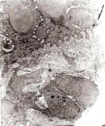 Fig. 4 En esta micrografía se puede apreciar abundante colágeno (¤), y fibroblastos de forma atípica (●). Barra: 2µm.