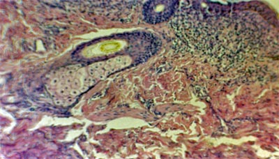 Fig. 1 Cortes histologicos de muestras de cuero cabelludo. Hematoxilina eosina