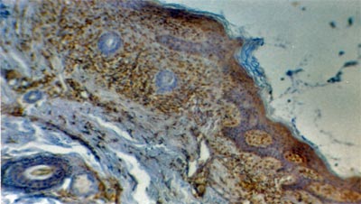 Fig. 2 Inmunohistoquimica. Positividad a S-100 en lesiones de cuero cabelludo
