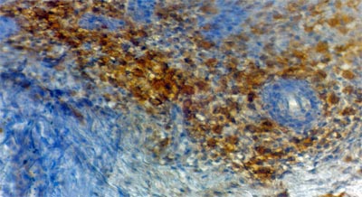 Fig. 3 Inmunohistoquimica. Positividad a CD1a en lesion de cuero cabelludo