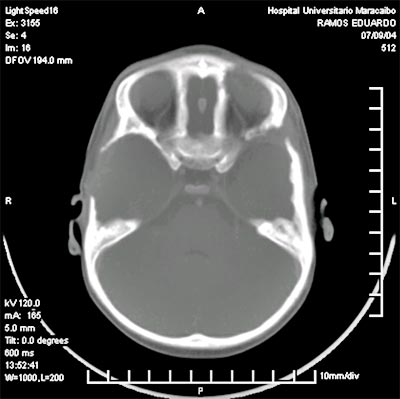 Fig. 4 Afectacion de las paredes de orbitarias, y arco cigomatico izquierdo. Tomografia axial computarizada