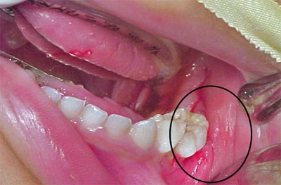 Fig. 5 Recesion gingival en 74 y 75