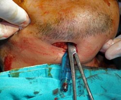 Figura 5 A: Aprehensión del cuff desinsuflado con la pinza hemostática y pasado a través de la ruta submentonia.