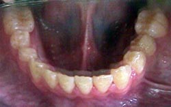 FIGURA 19 Foto Intrabucal Oclusal Inferior