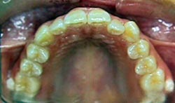 FIGURA 4 Foto Intrabucal Oclusal superior