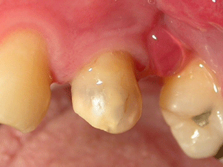 Fig. I: Primer premolar superior con necesidad de tratamiento endodóntico.