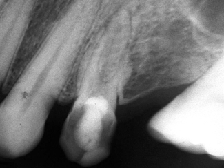 Fig. II: Imagen radiográfica de primer premolar superior, sugiriendo la presencia de tres conductos radiculares..