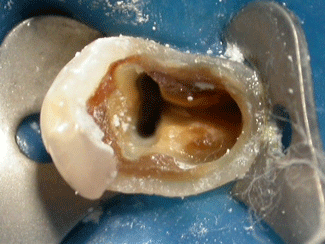 Fig. III: Aspecto de la cámara pulpar después de la remoción de la restauración provisional.